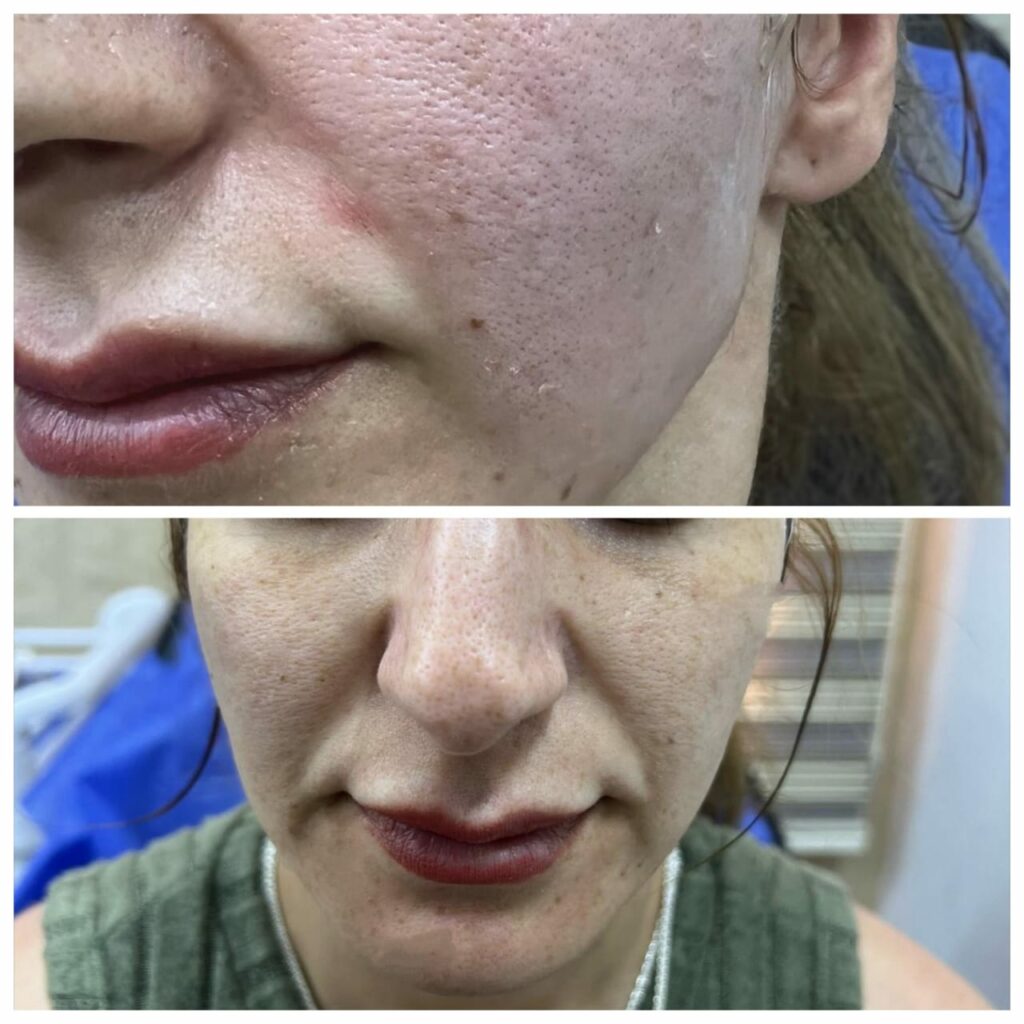 Improving lines around the mouth with threads